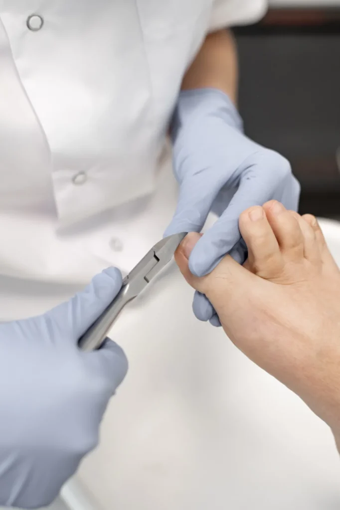 Podoloog behandelt een ingegroeide teennagel met handschoenen en instrument