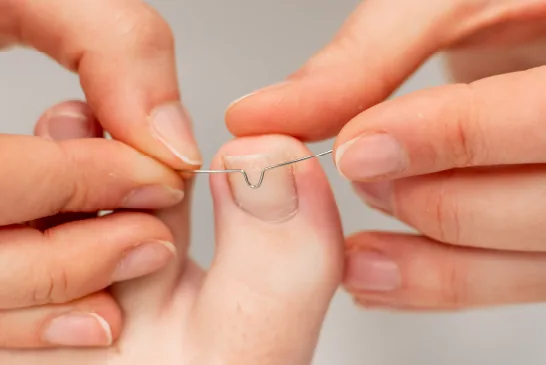 Nagelbeugels worden op de nagel van de patiënt geplaatst.