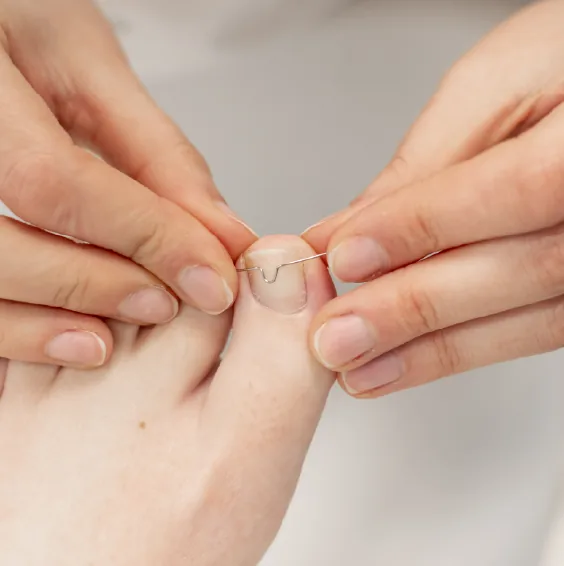 Voetzorg 5 Nagelverzorging Brugge – Specialistische correctiebehandeling voor een gezonde teennagel.